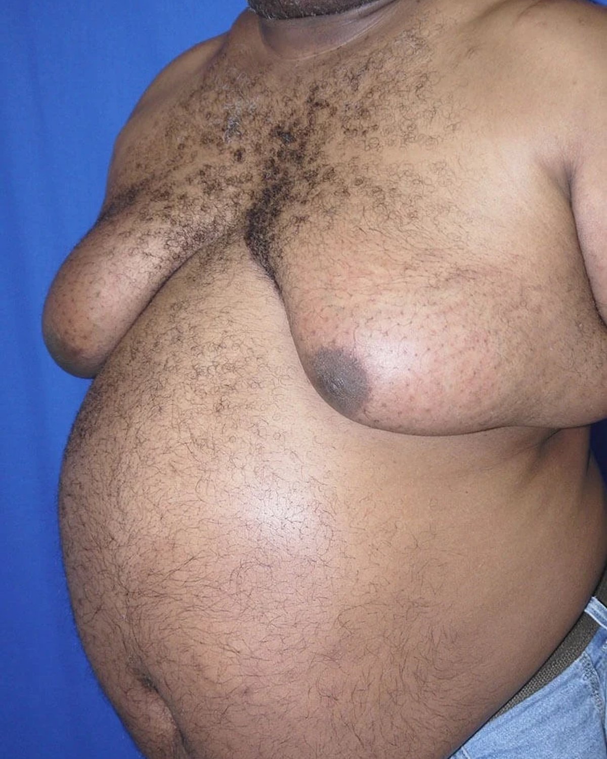 One-Stitch Gynecomastia before
