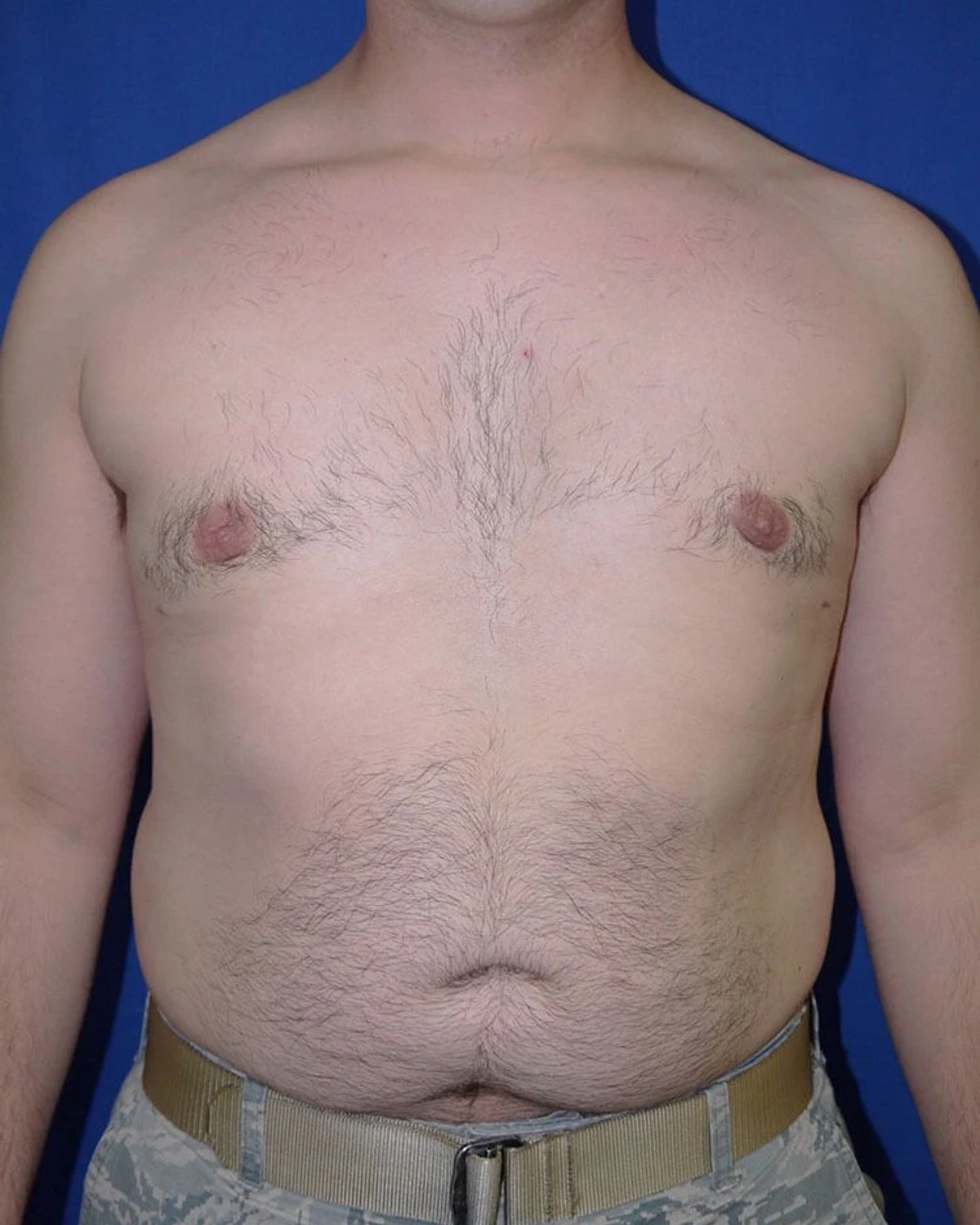 One-Stitch Gynecomastia after
