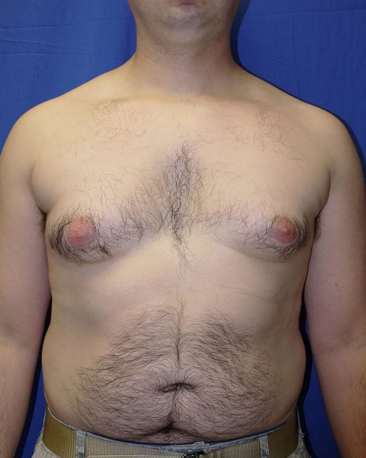 One-Stitch Gynecomastia before