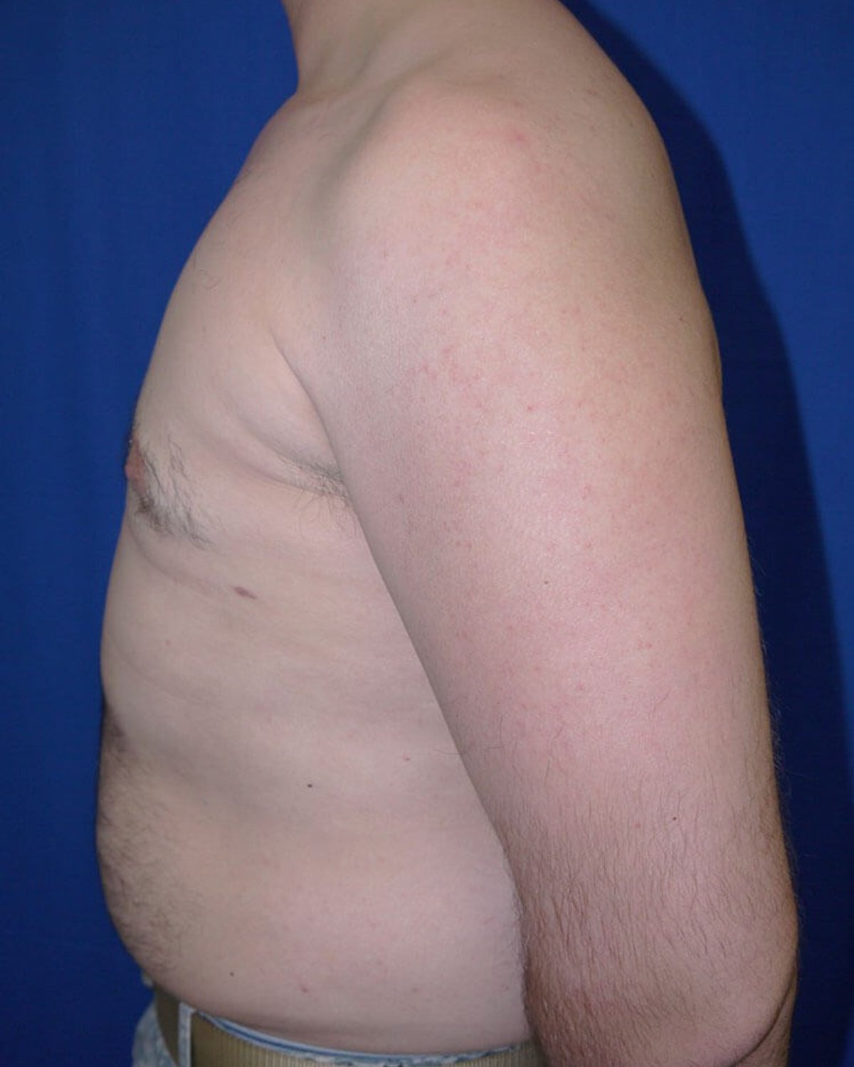 One-Stitch Gynecomastia — Left Profile view, after