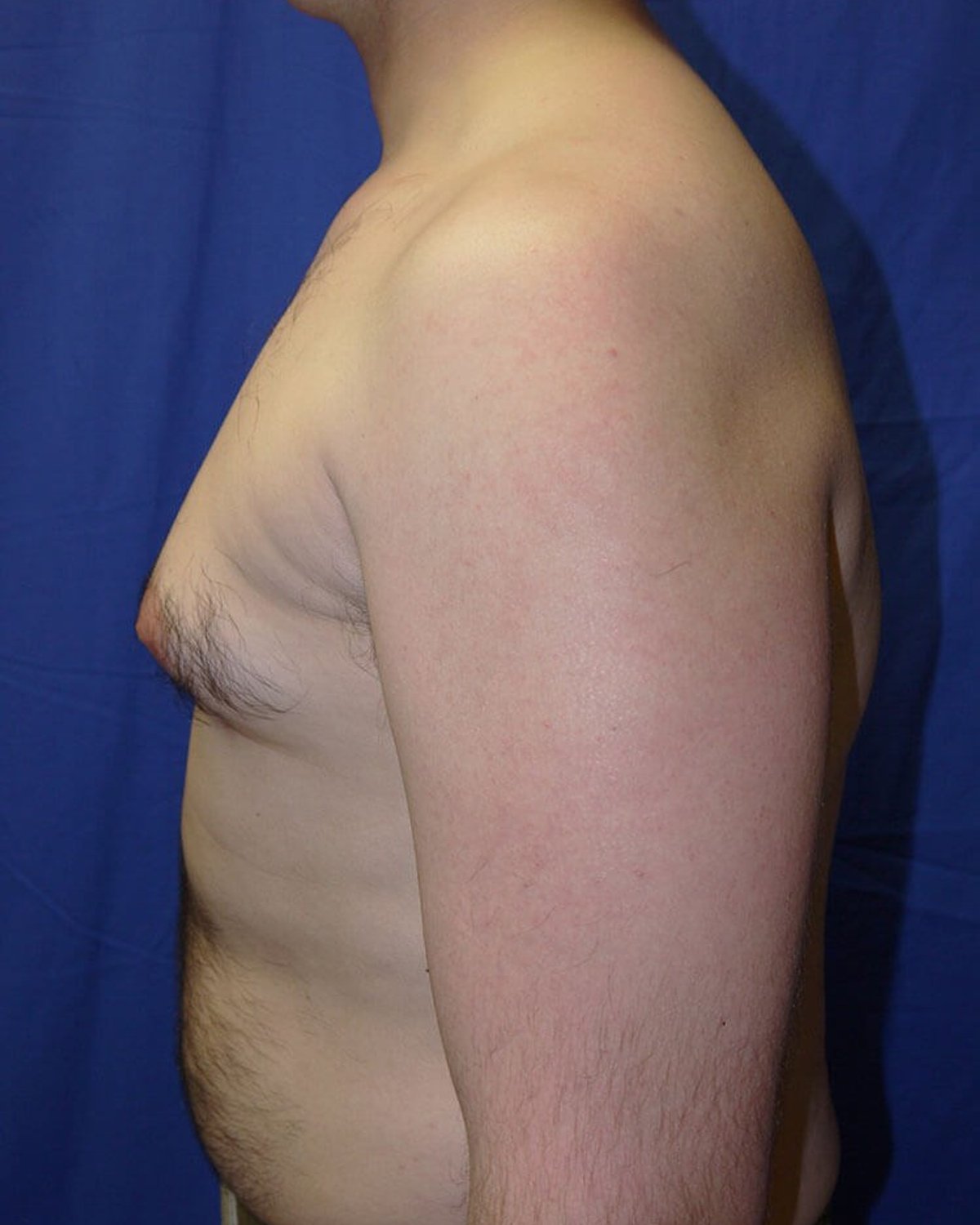 One-Stitch Gynecomastia — Left Profile view, before