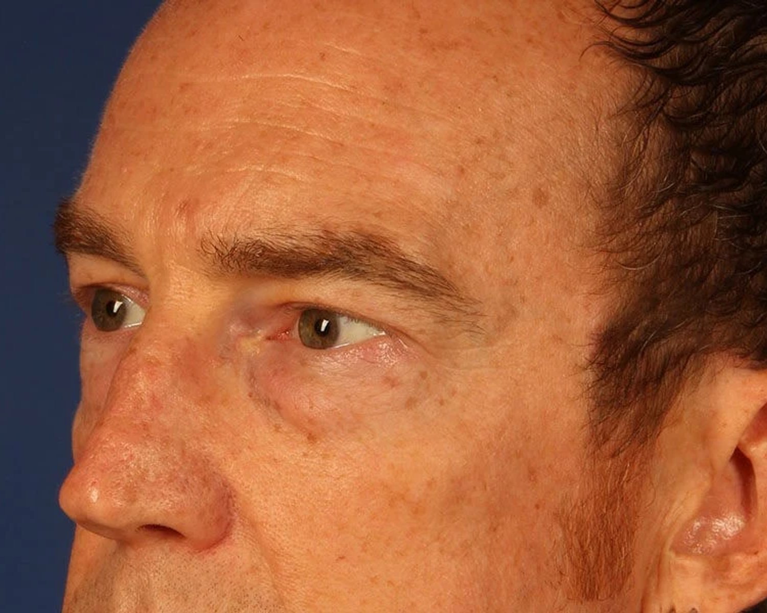 Eyelid Surgery — Oblique Right view, before
