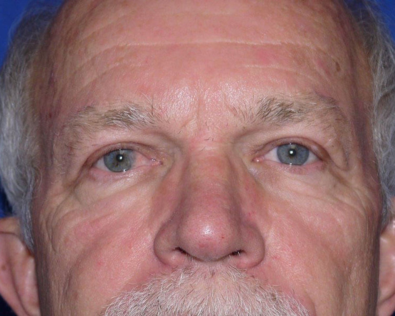 Eyelid Surgery after