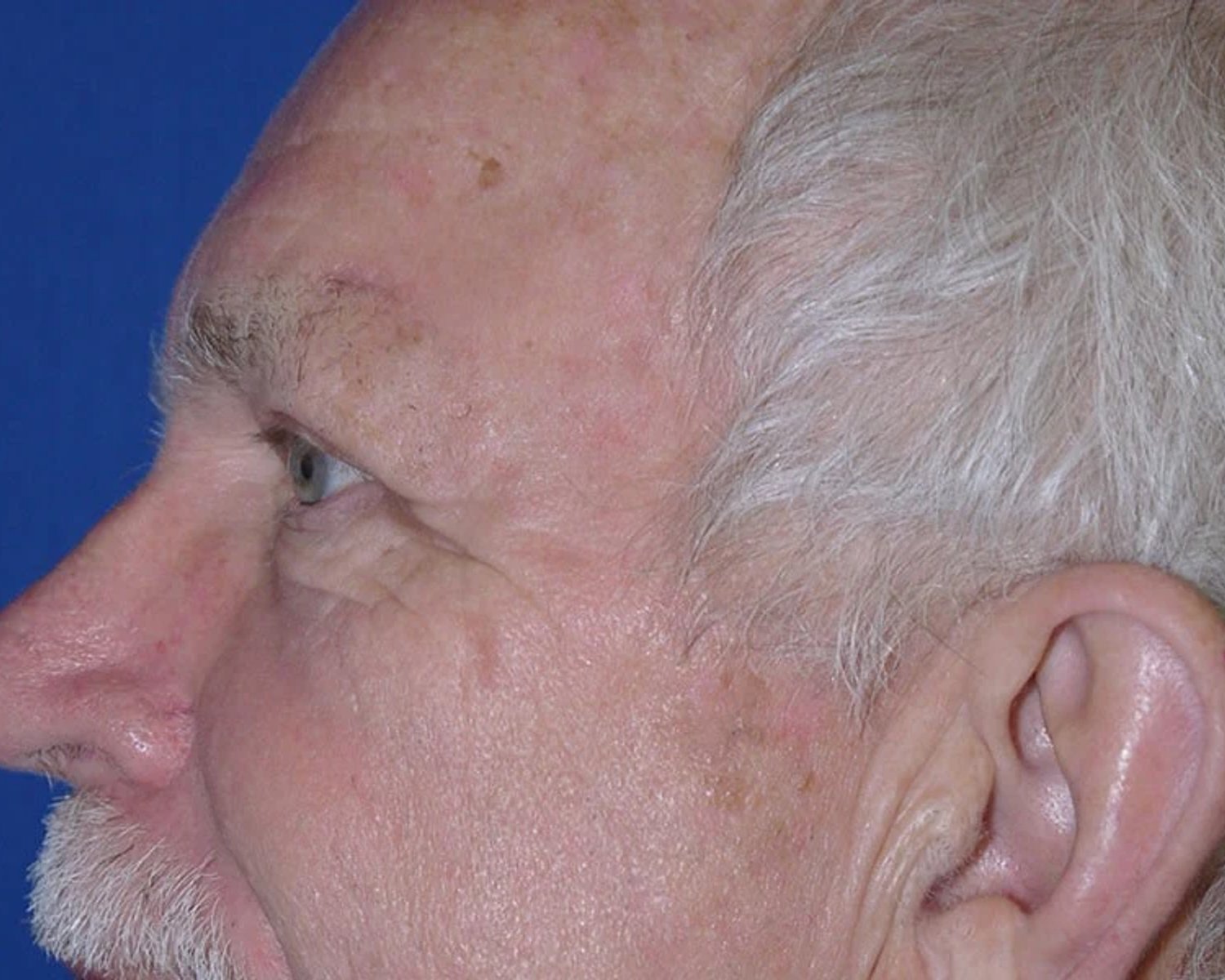 Eyelid Surgery — Oblique Left view, after