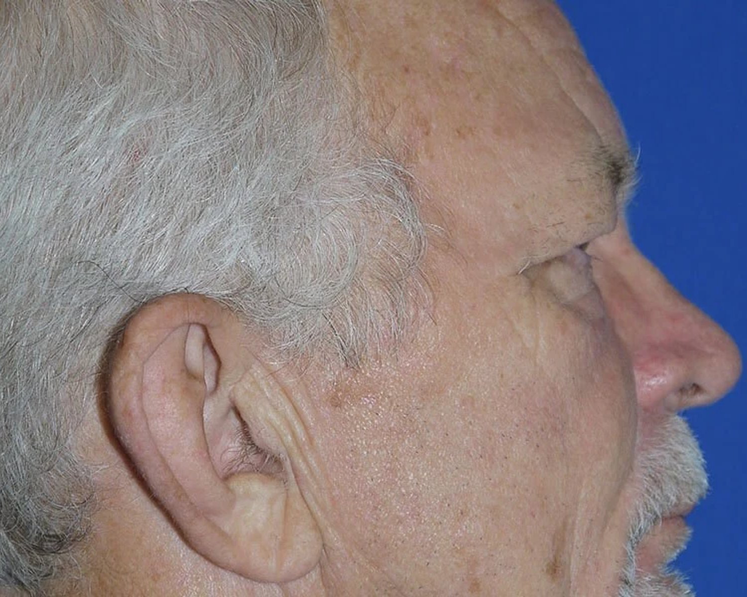 Eyelid Surgery — Oblique Right view, before
