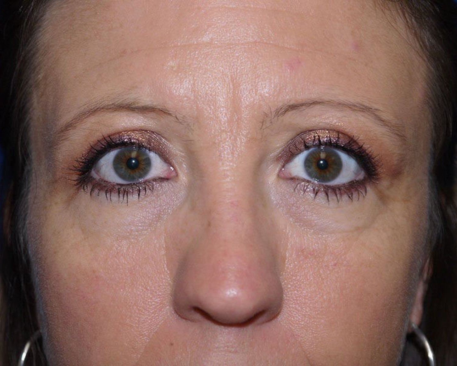 Eyelid Surgery after