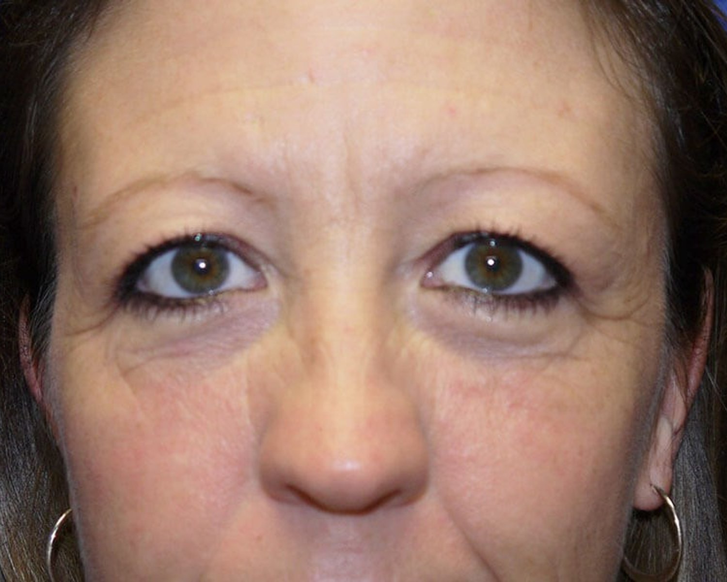 Eyelid Surgery before