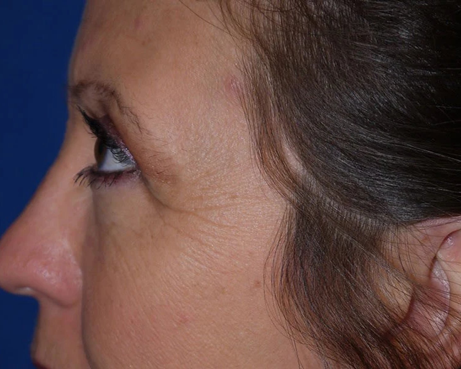 Eyelid Surgery — Oblique Left view, after