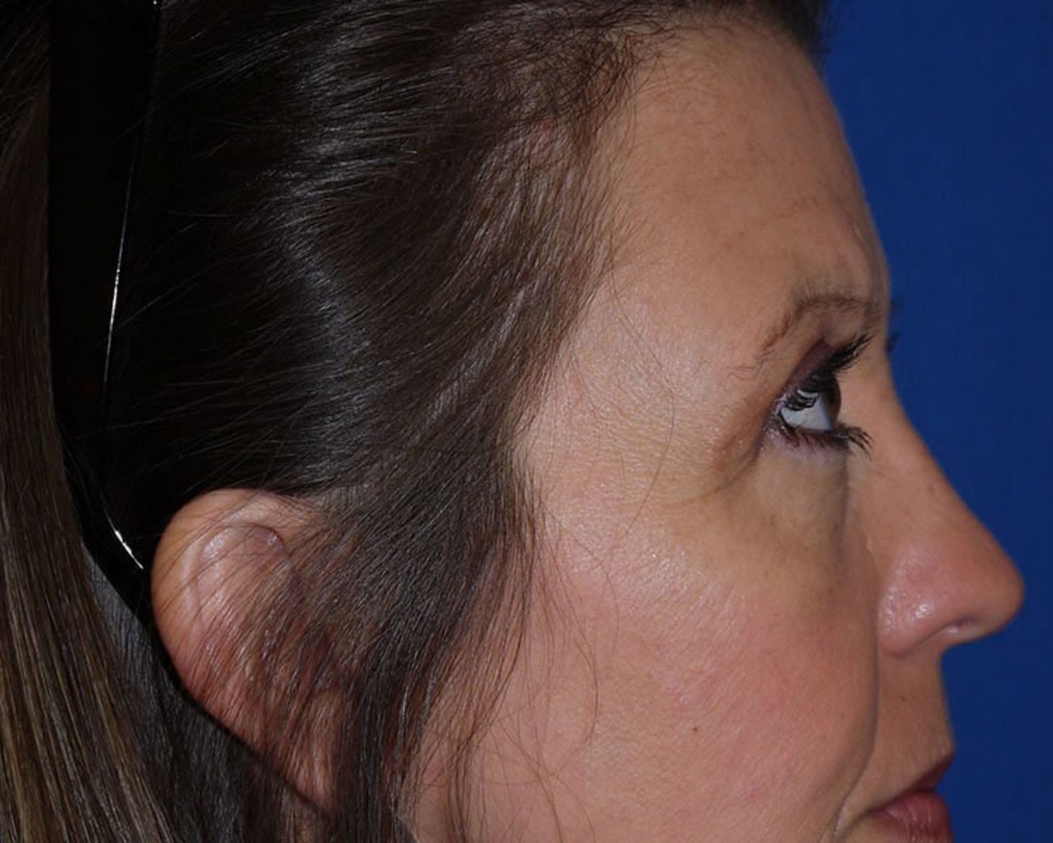 Eyelid Surgery — Oblique Right view, after