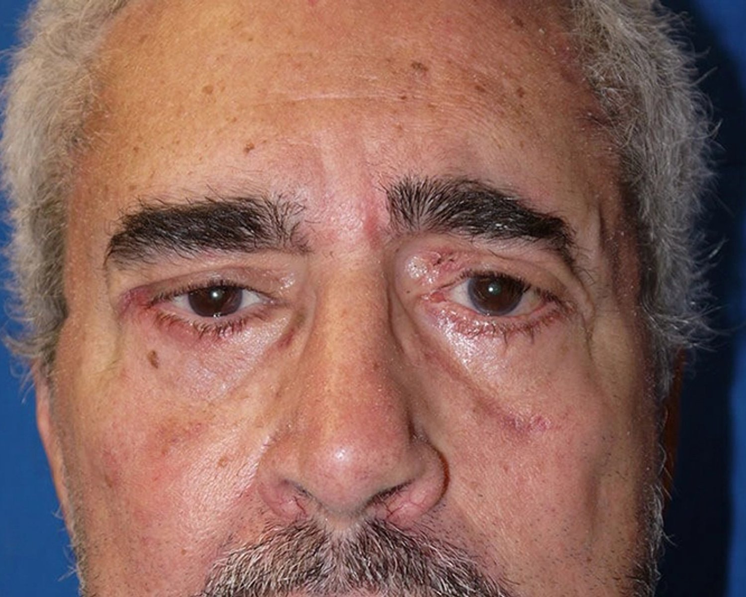 Eyelid Surgery after