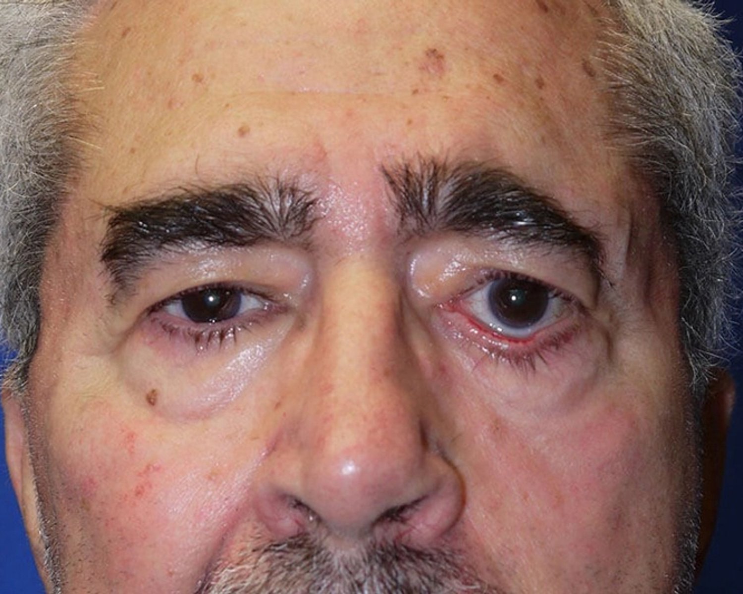 Eyelid Surgery before