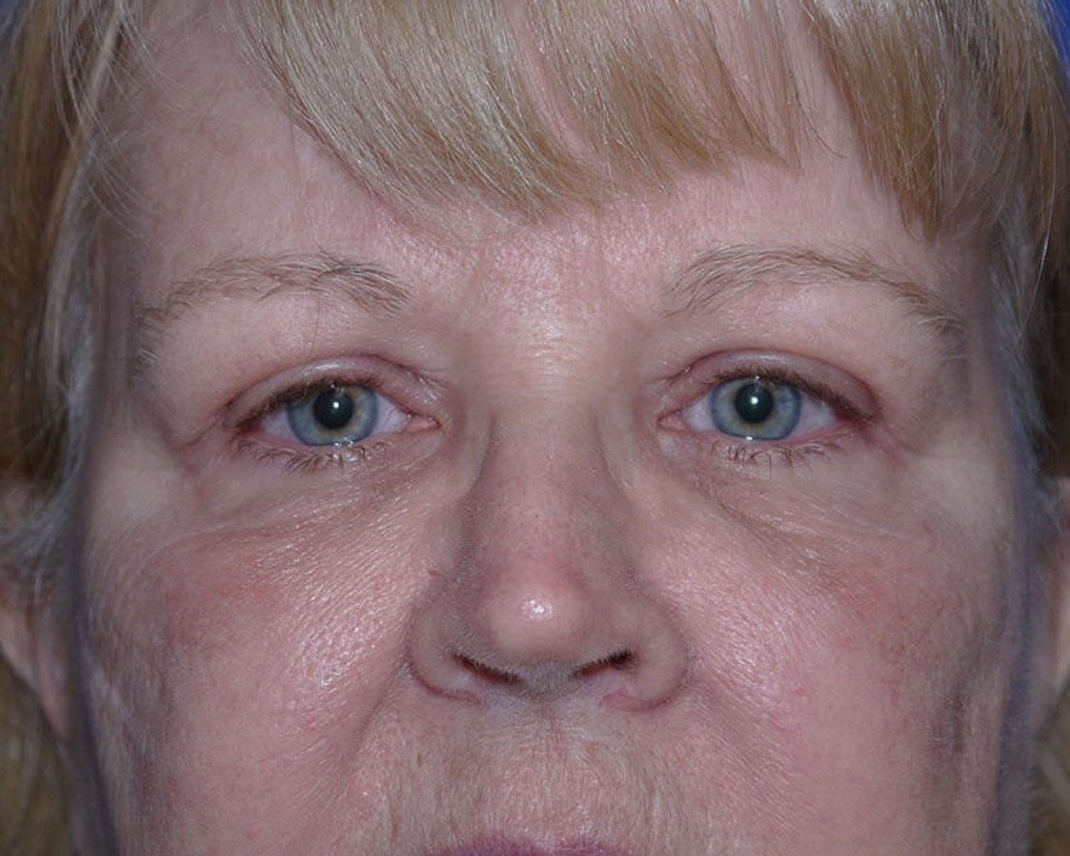 Eyelid Surgery after