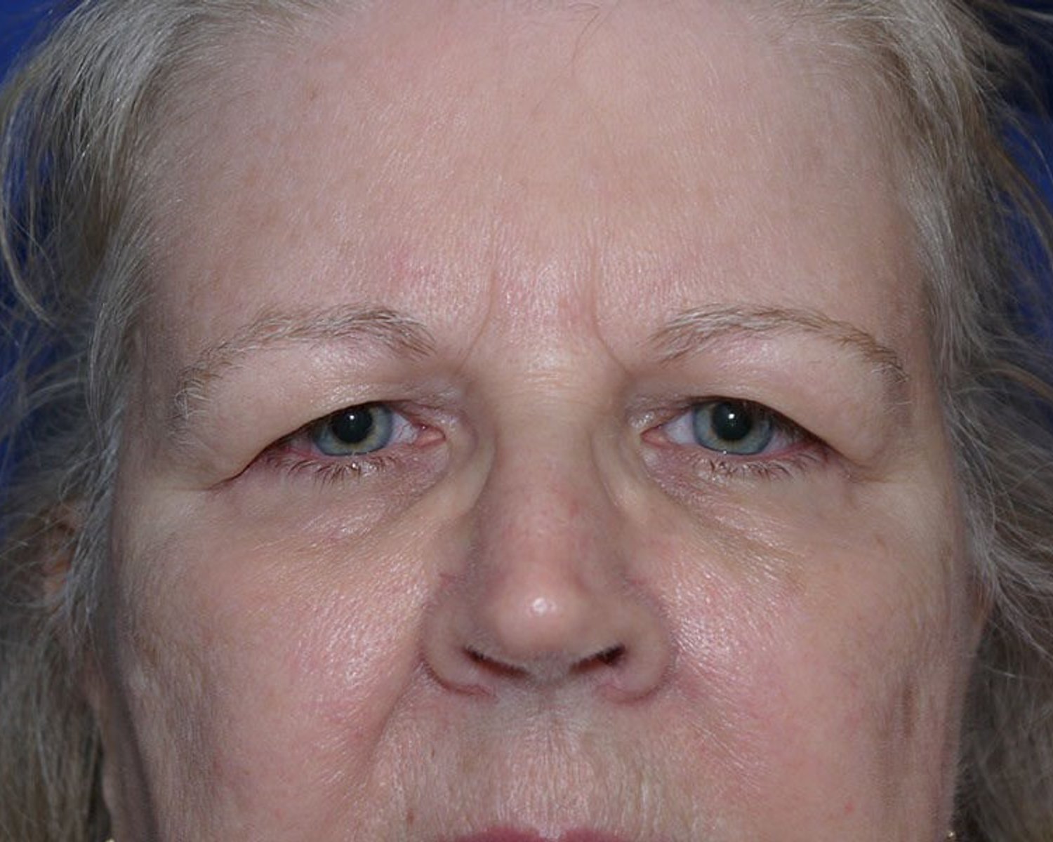 Eyelid Surgery before