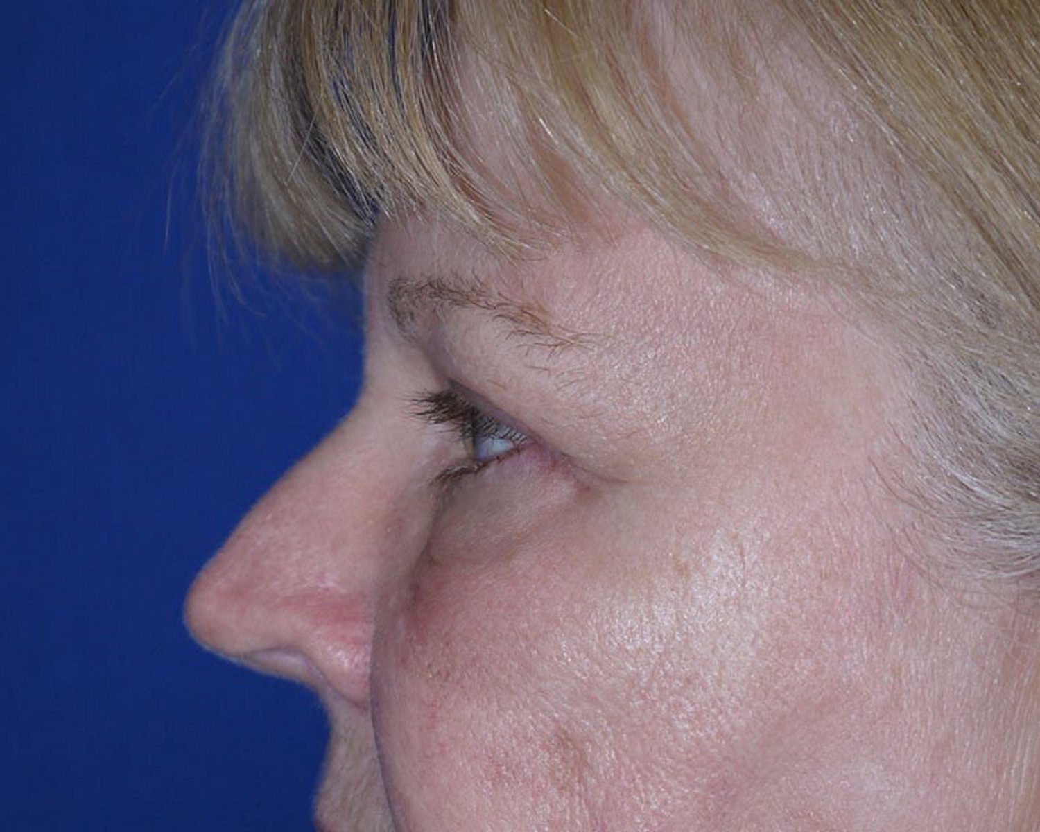 Eyelid Surgery — Oblique Left view, after