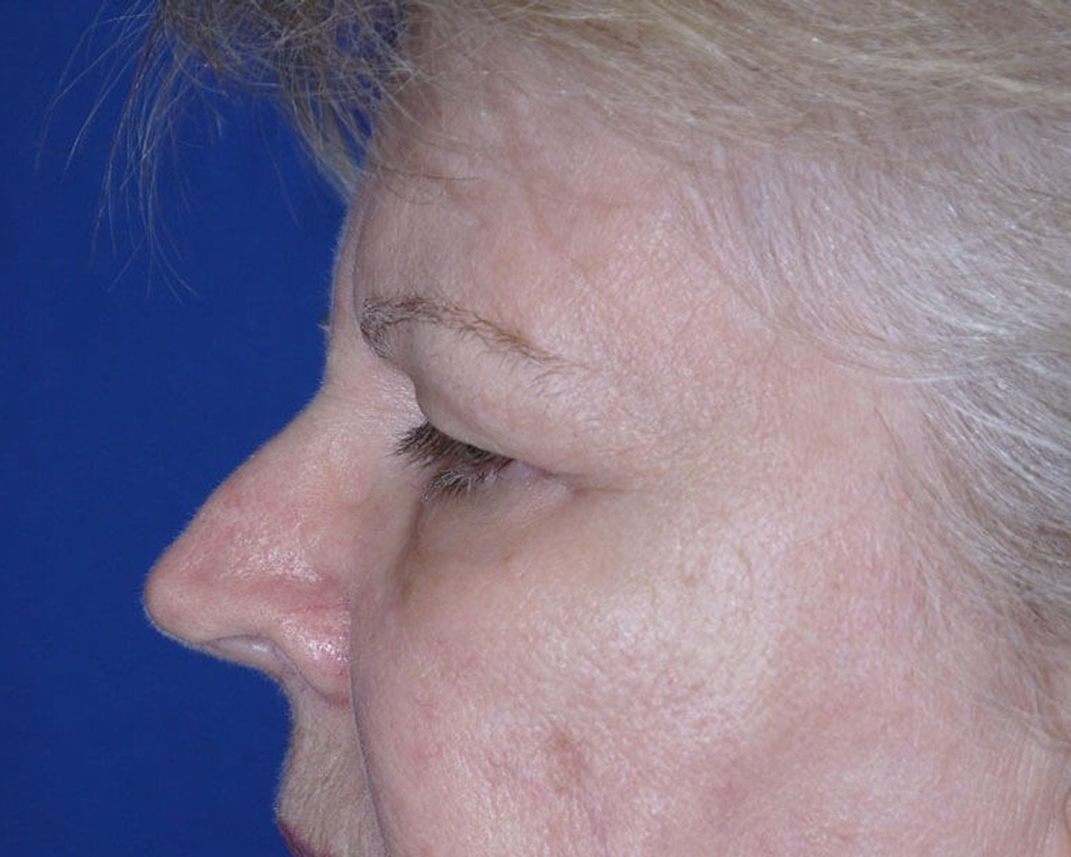 Eyelid Surgery — Oblique Left view, before