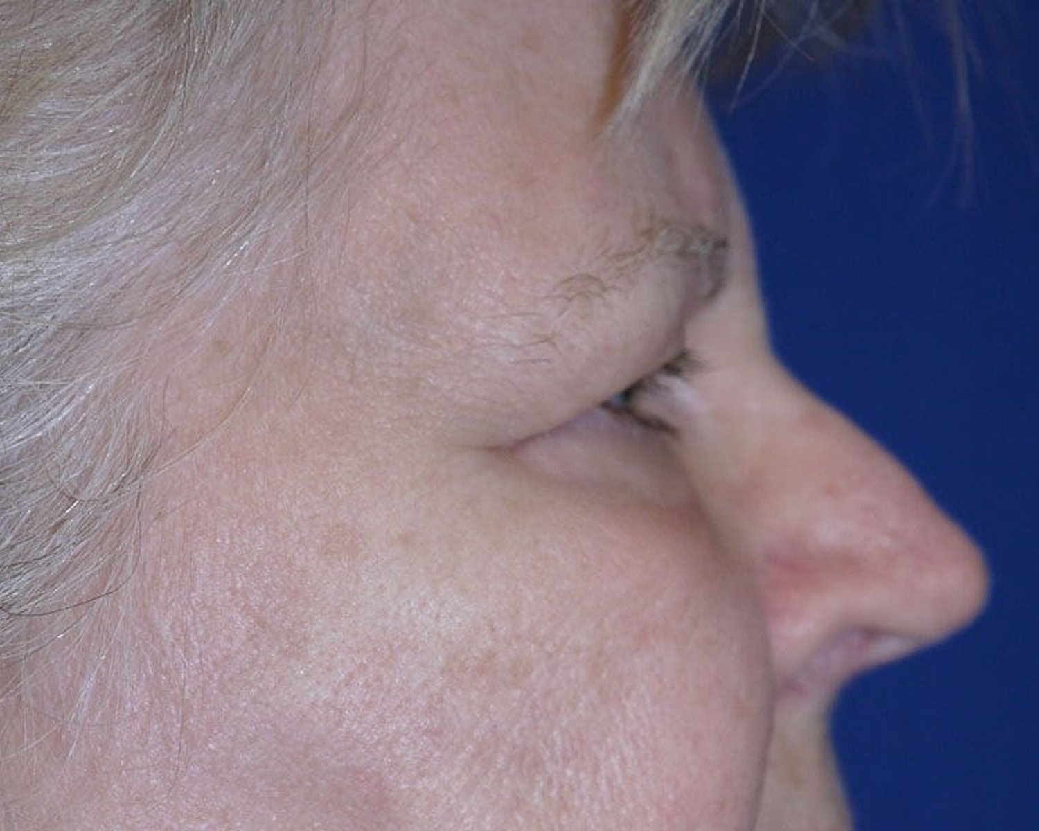 Eyelid Surgery — Oblique Right view, before
