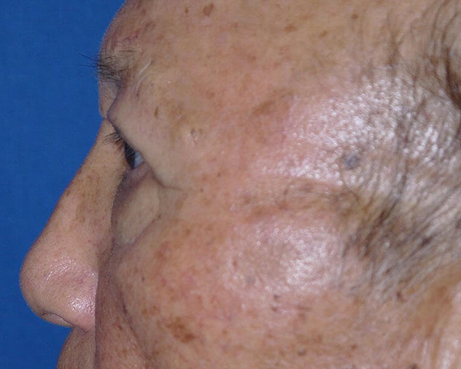 Eyelid Surgery — Left Profile view, after