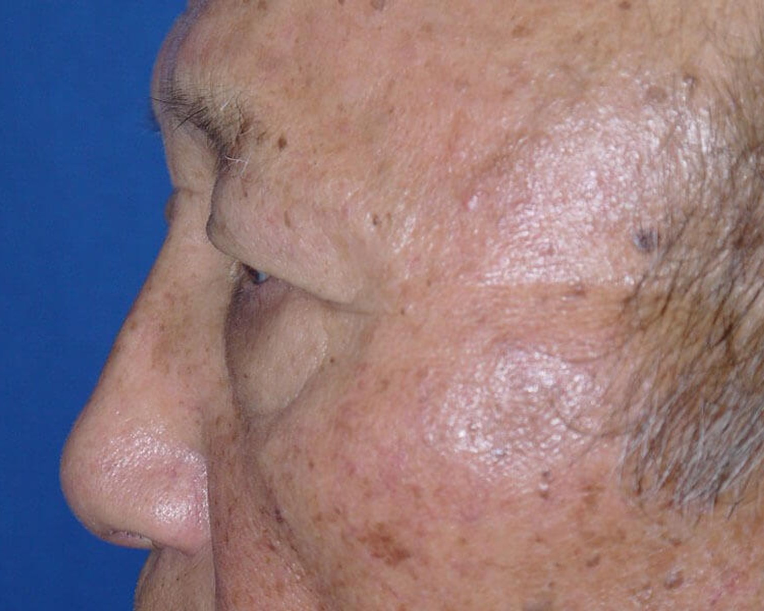 Eyelid Surgery — Left Profile view, before