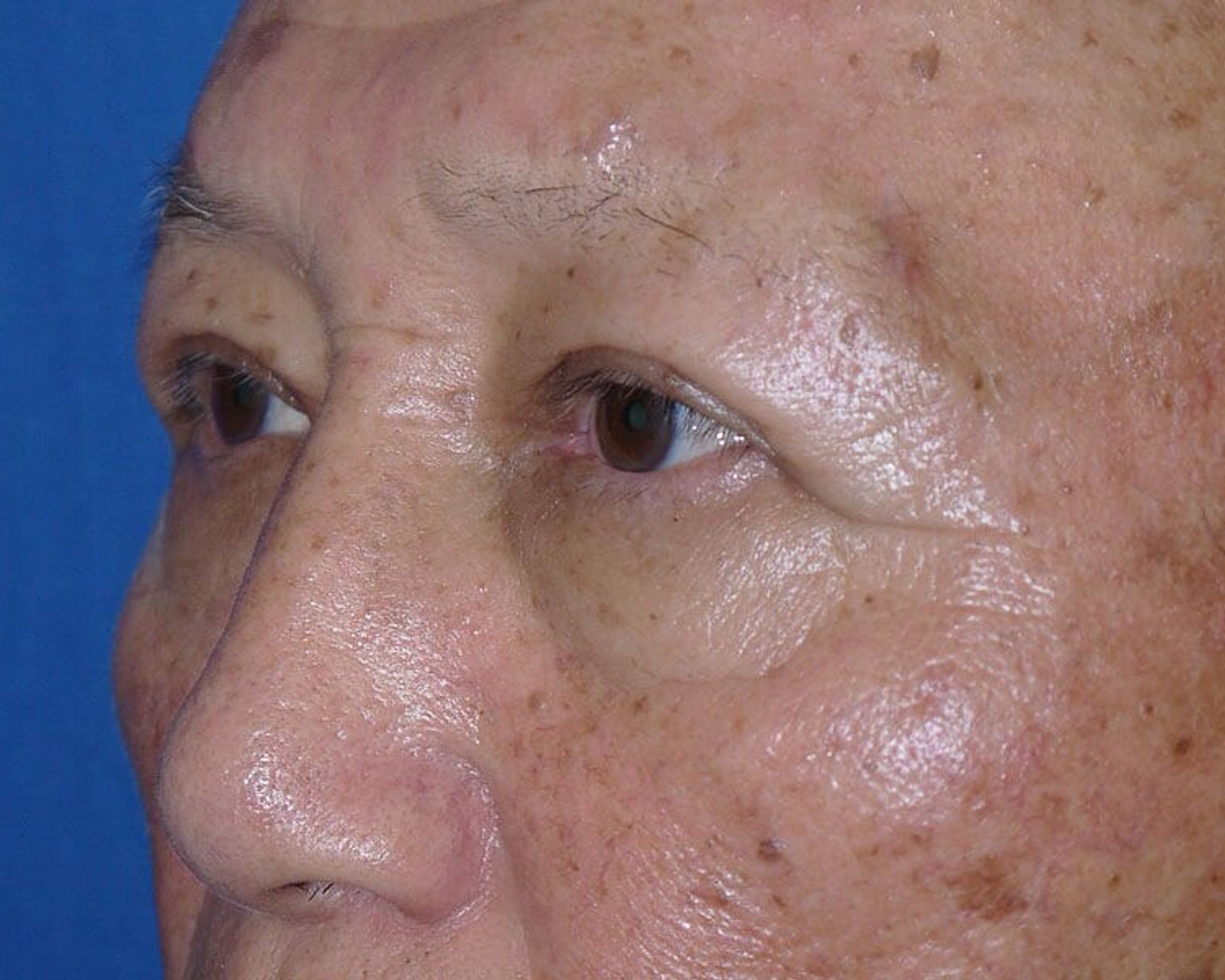 Eyelid Surgery — Oblique Right view, after