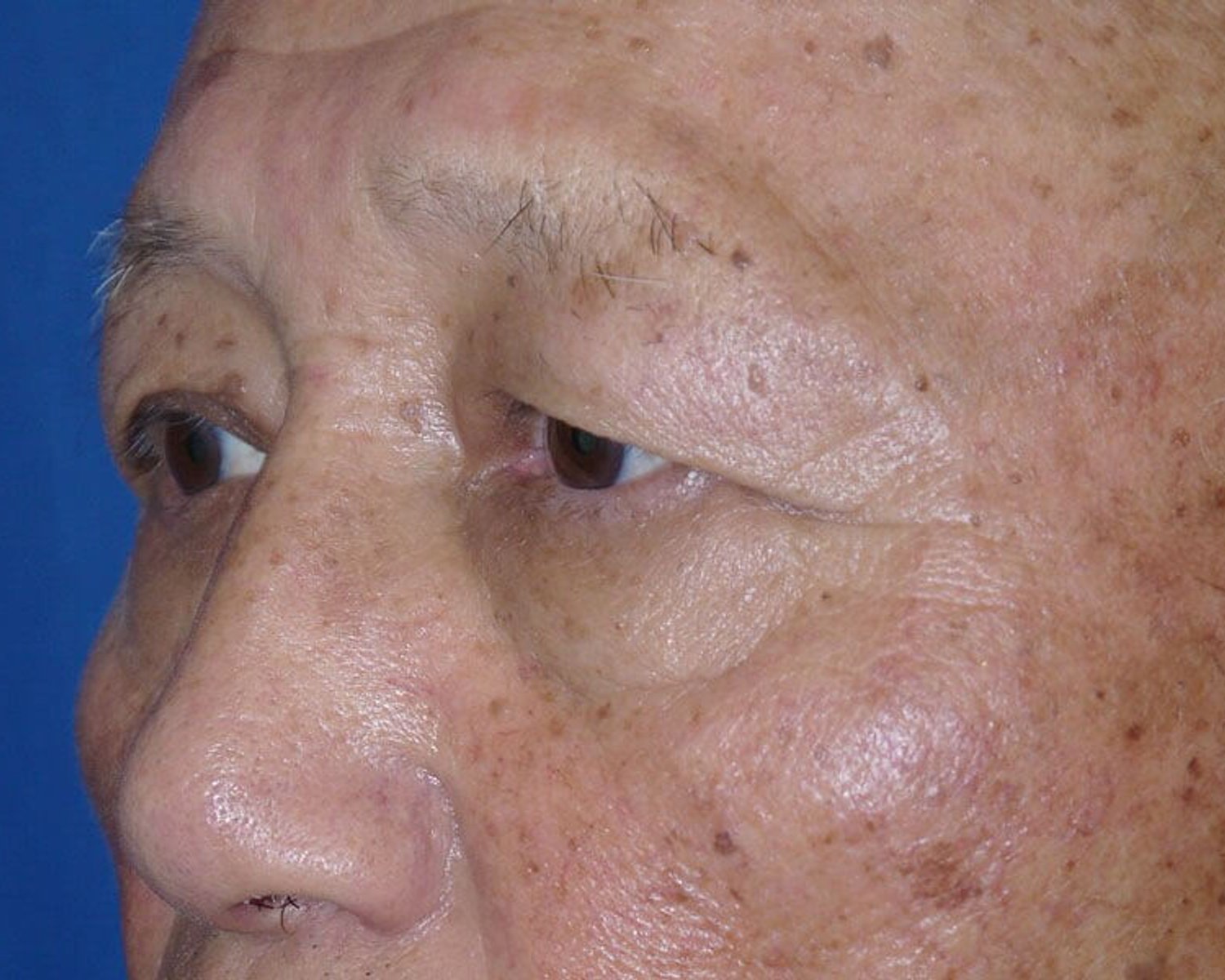 Eyelid Surgery — Oblique Right view, before
