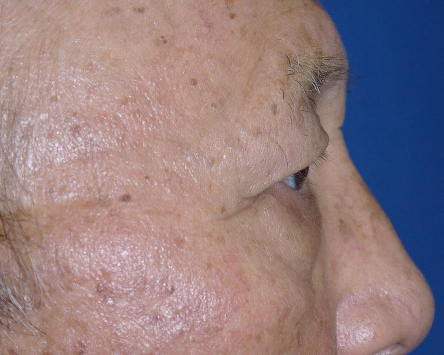 Eyelid Surgery — Right Profile view, before
