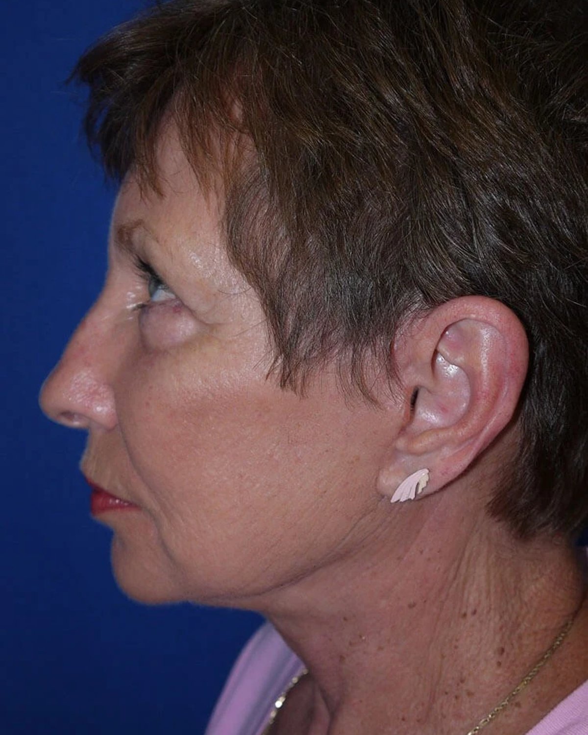 Necklift — Left Profile view, after