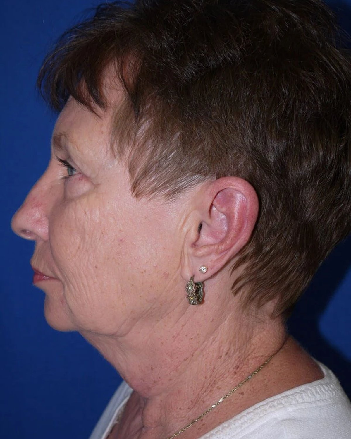 Necklift — Left Profile view, before