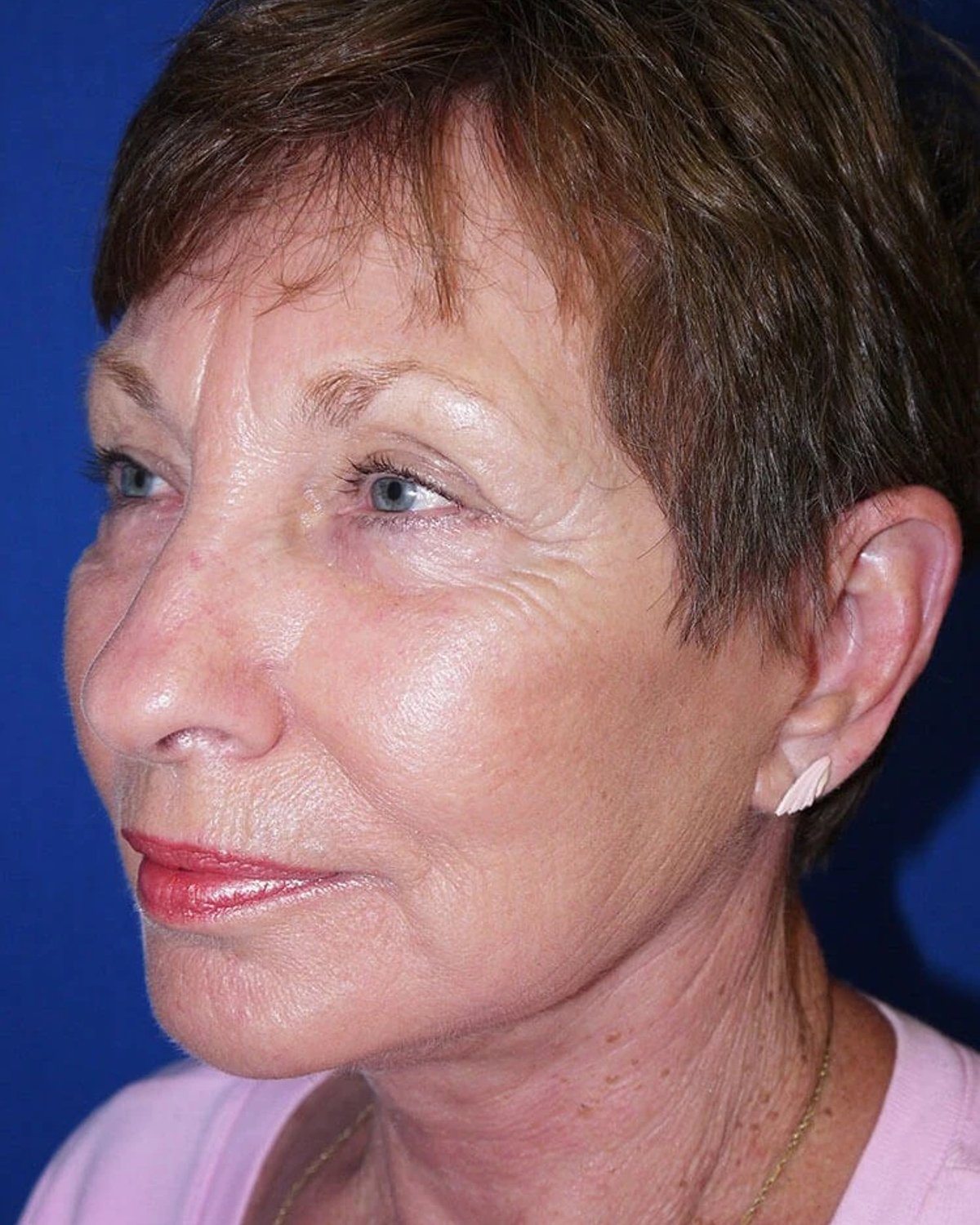 Necklift — Oblique Right view, after