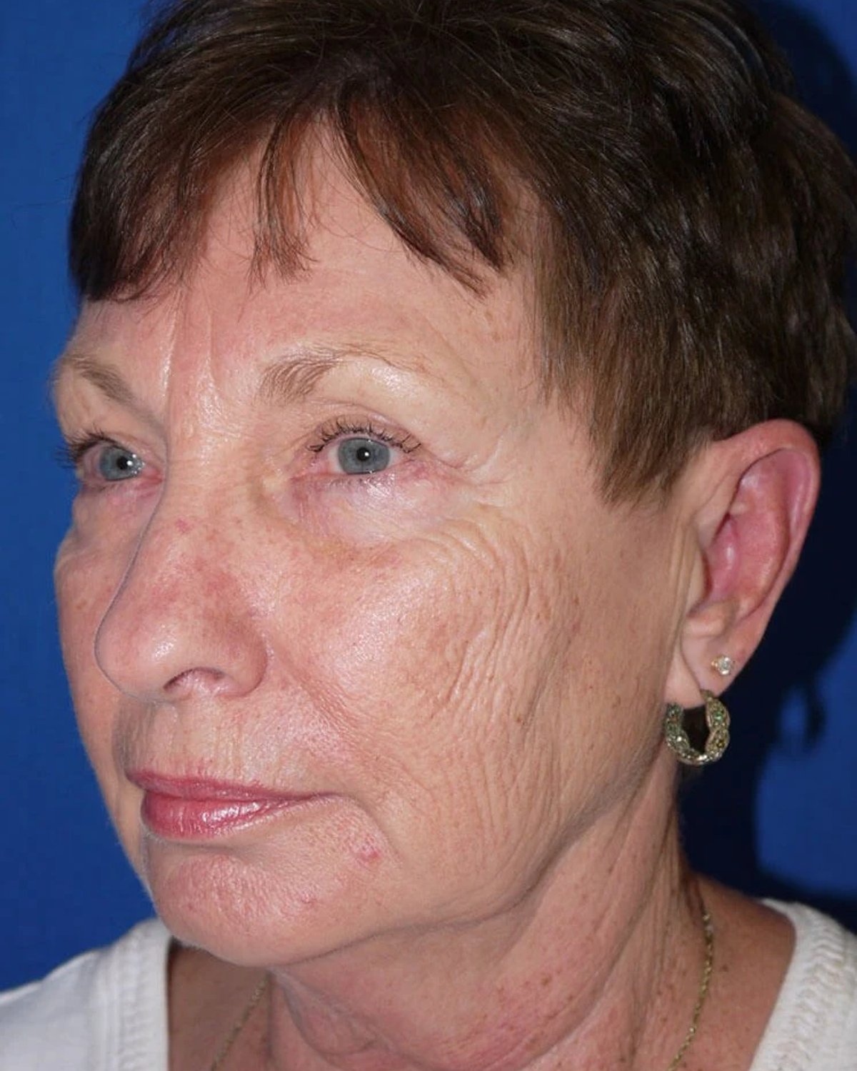 Necklift — Oblique Right view, before