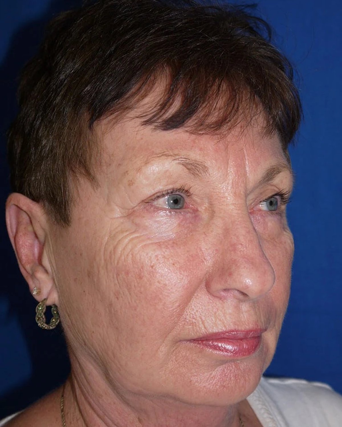 Before Necklift
