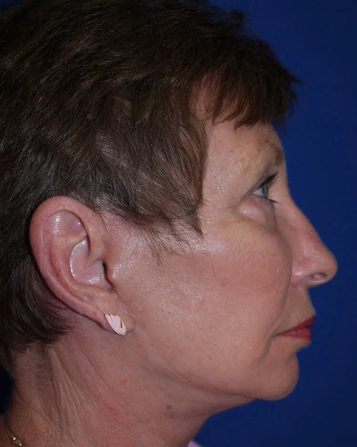 Necklift — Right Profile view, after