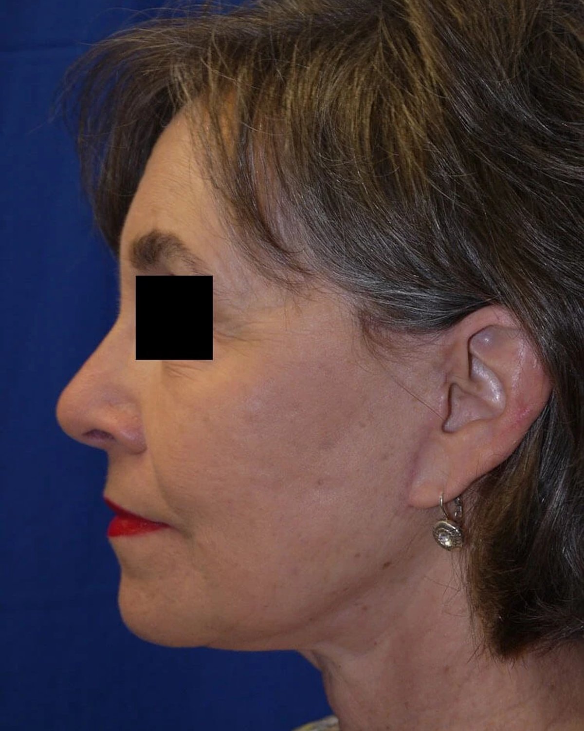 Facelift (neck lift included) — Left Profile view, after