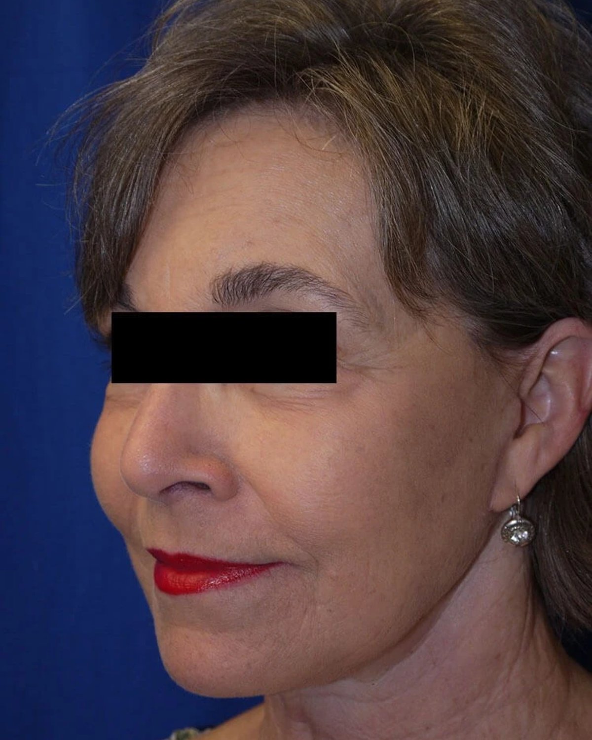 Facelift (neck lift included) — Right Profile view, after