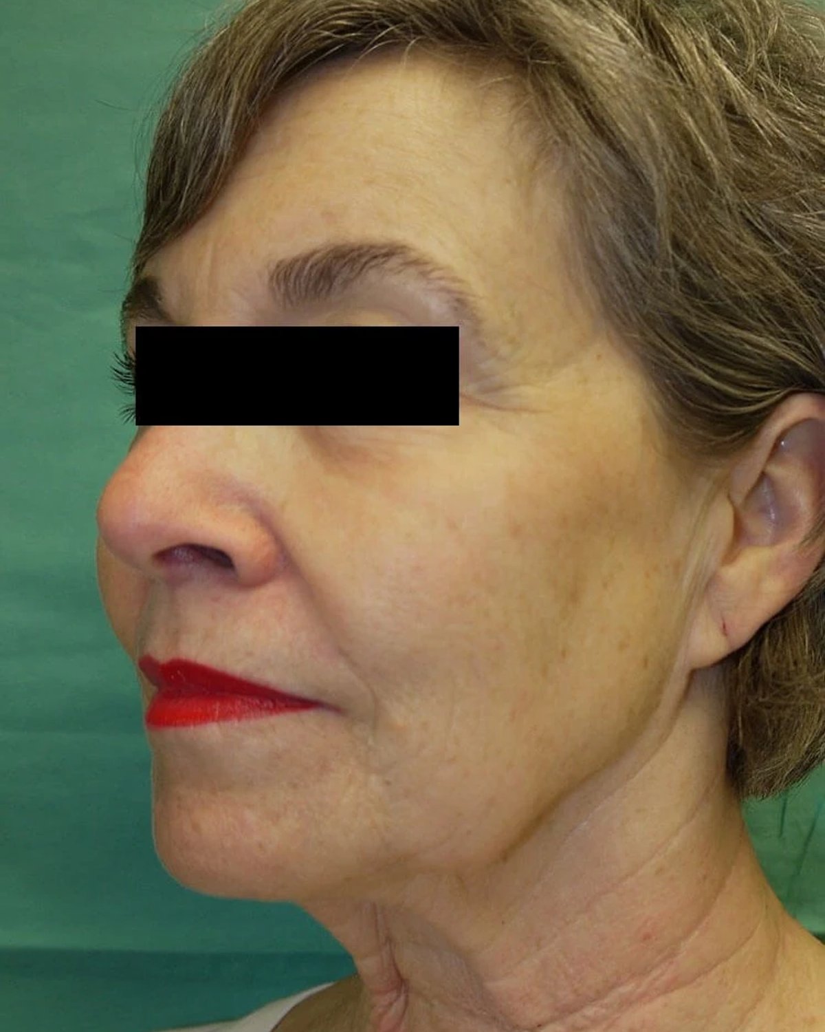 Facelift (neck lift included) — Right Profile view, before