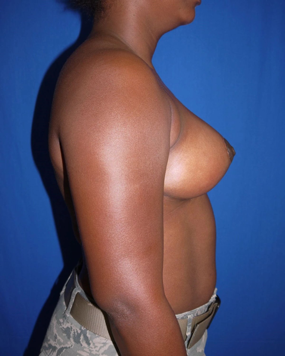 Breast Lift — Right Profile view, after