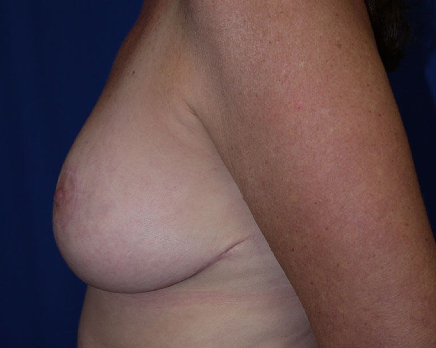 Breast Reduction — Left Profile view, after