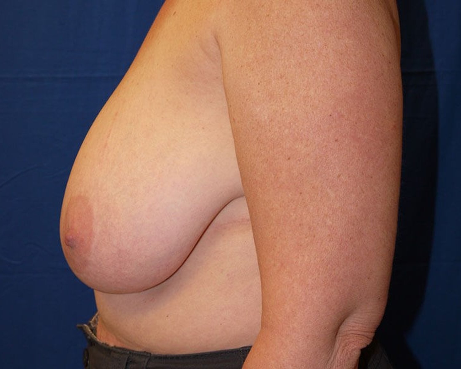 Breast Reduction — Left Profile view, before