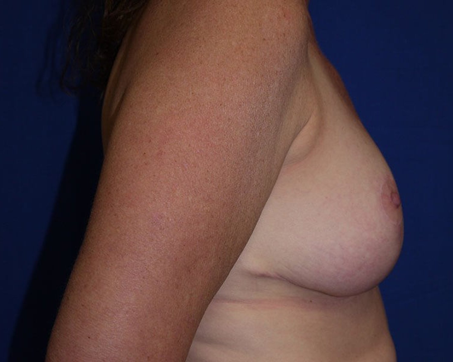 Breast Reduction — Right Profile view, after
