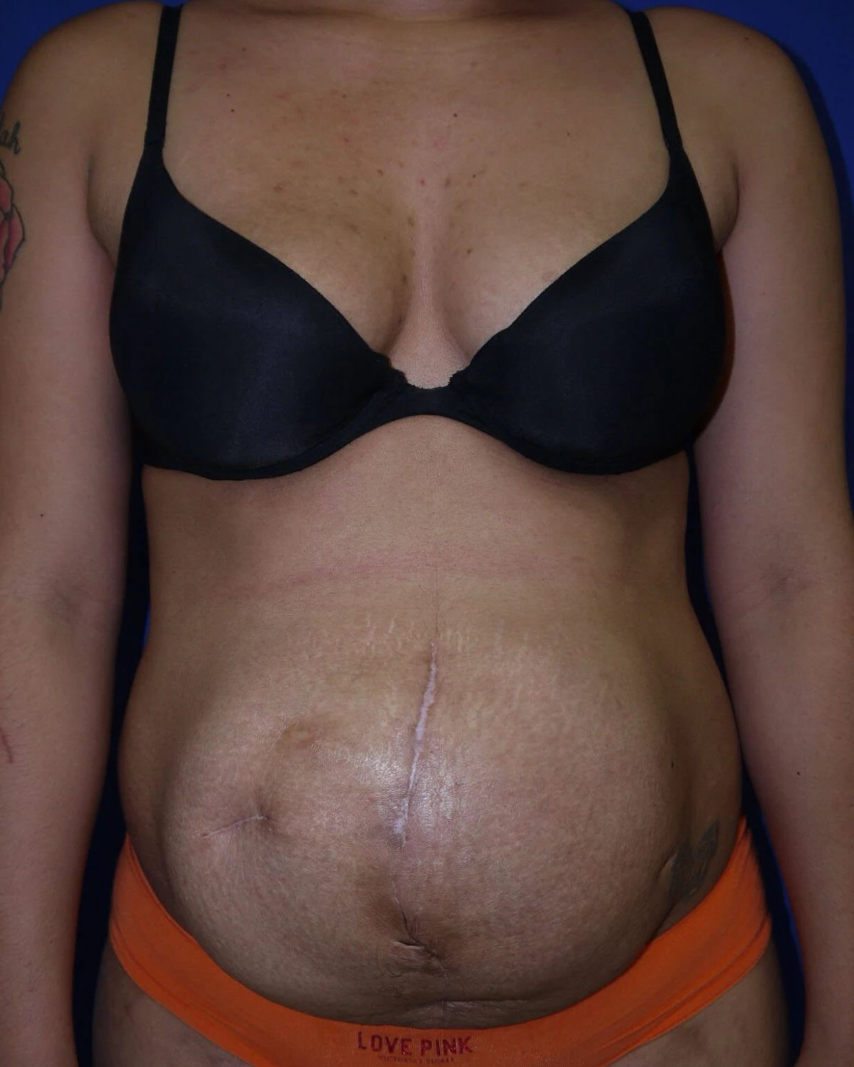 Tummy Tuck before