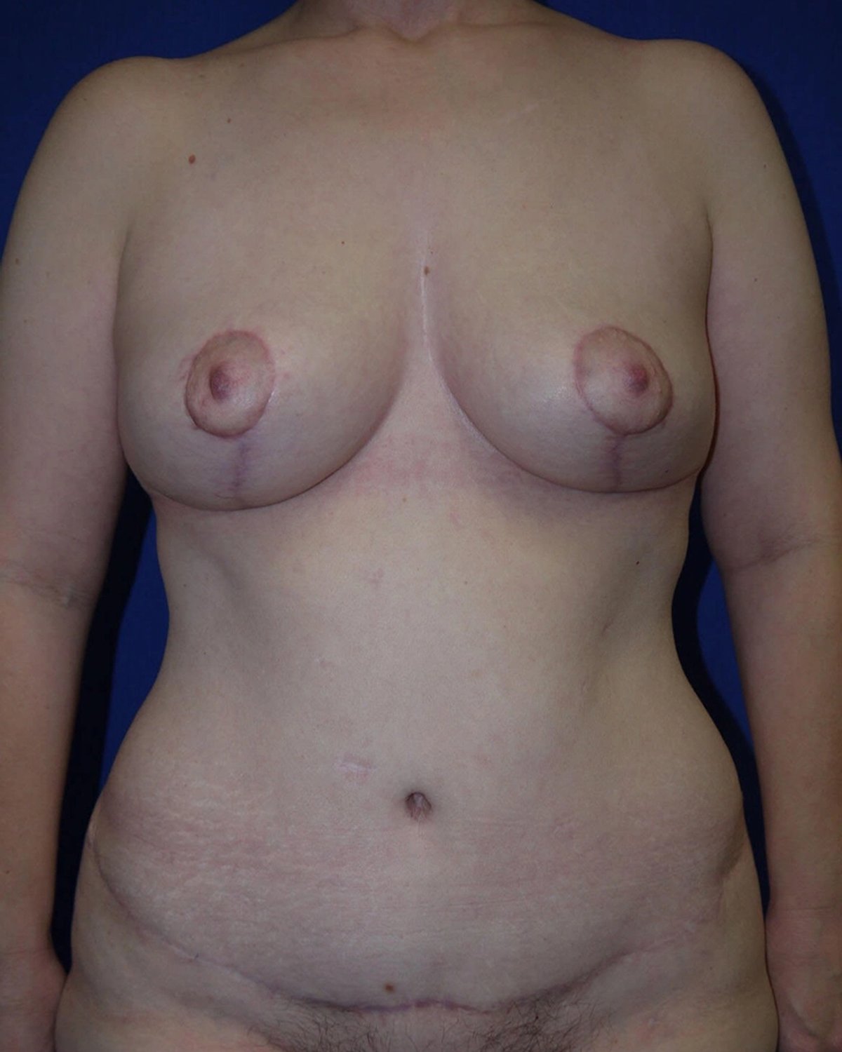 Breast Reduction after