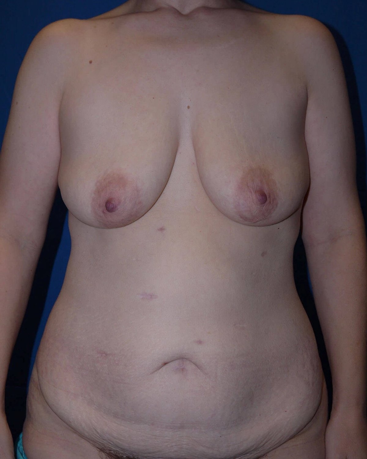 Breast Reduction before