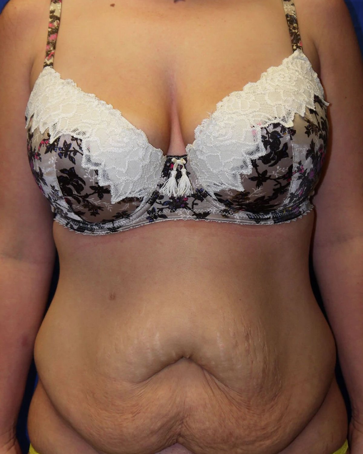 Tummy Tuck before