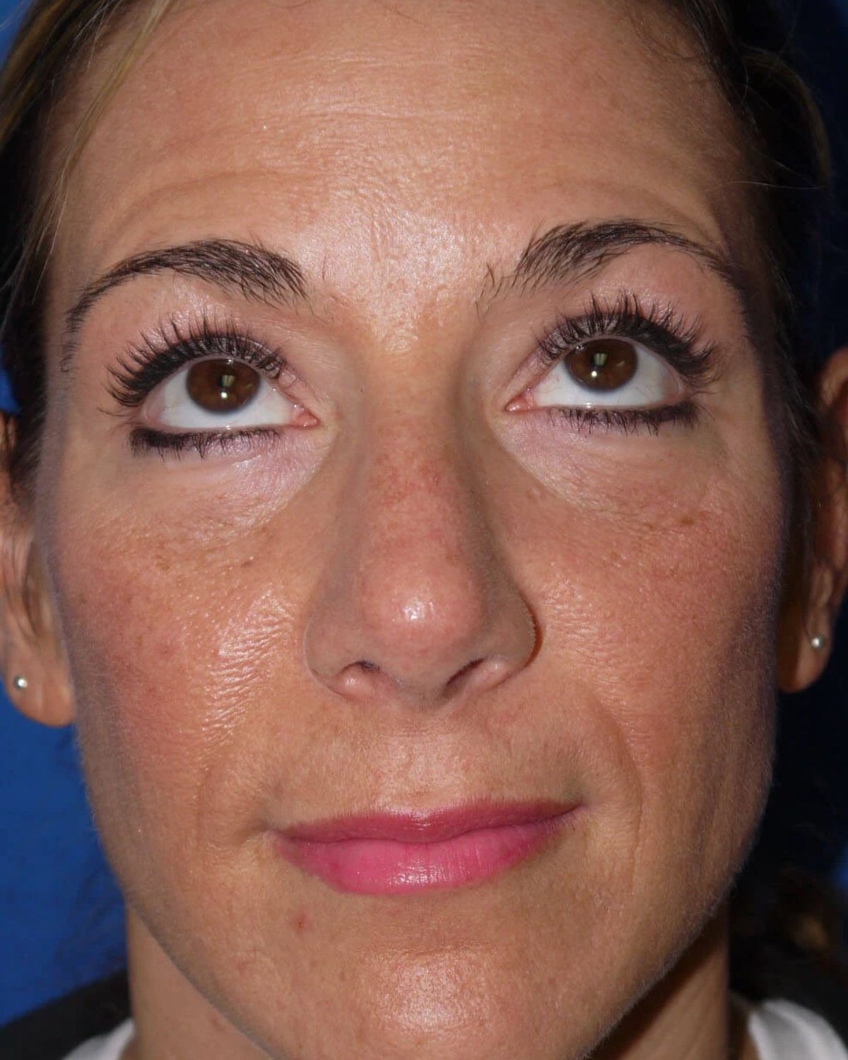 Rhinoplasty before