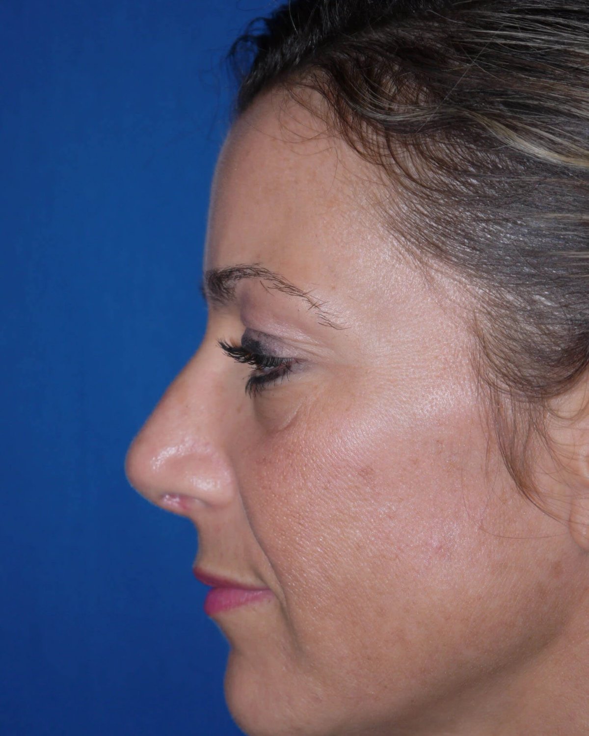 Rhinoplasty — Left Profile view, after