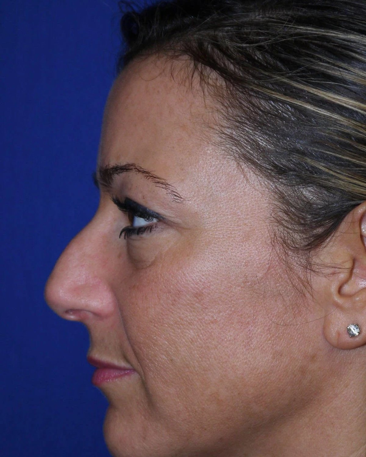 Rhinoplasty — Left Profile view, before