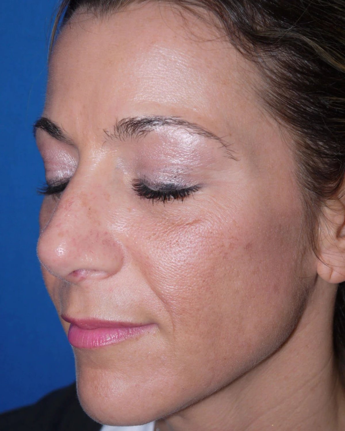 Rhinoplasty — Oblique Right view, after