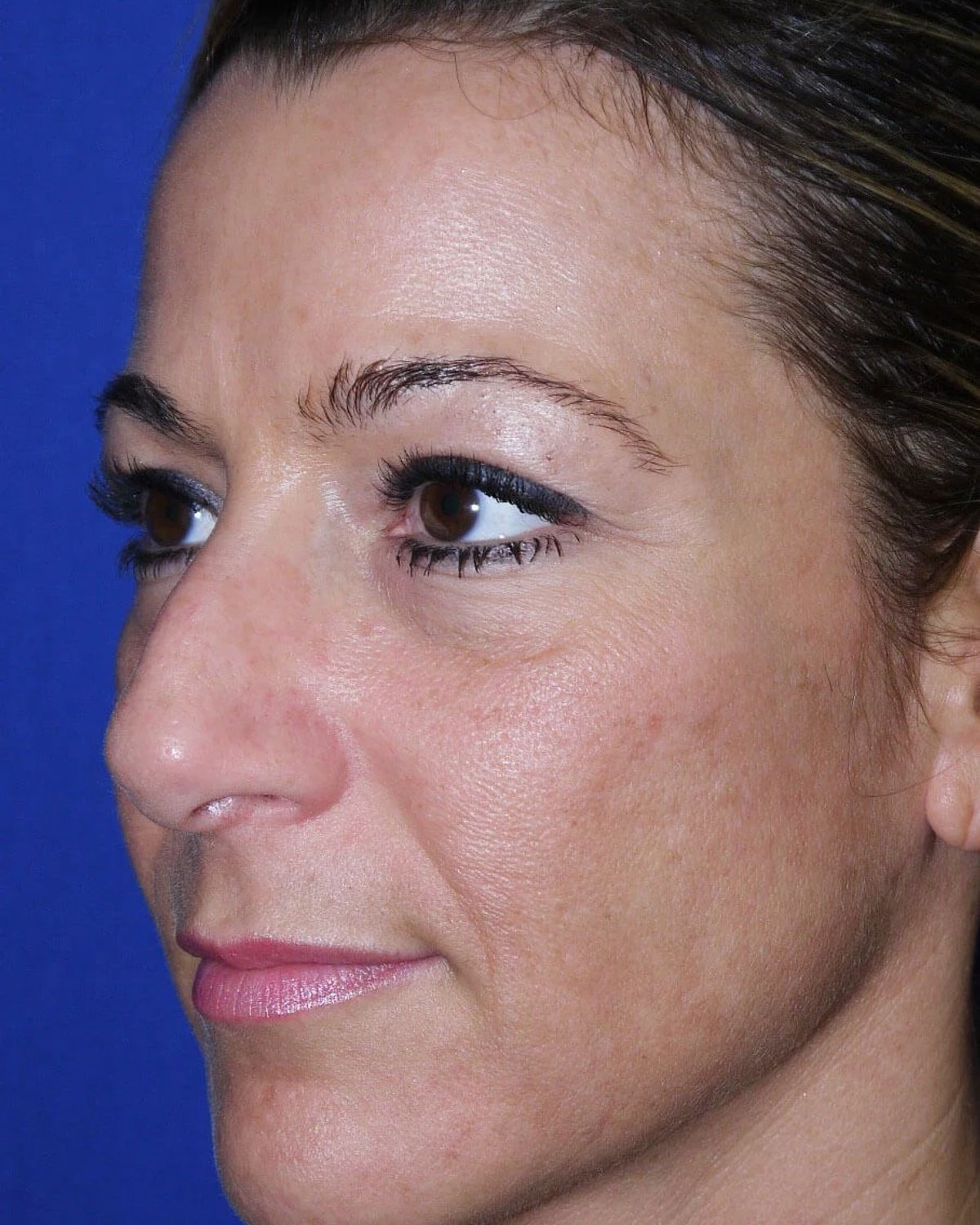 Rhinoplasty — Oblique Right view, before