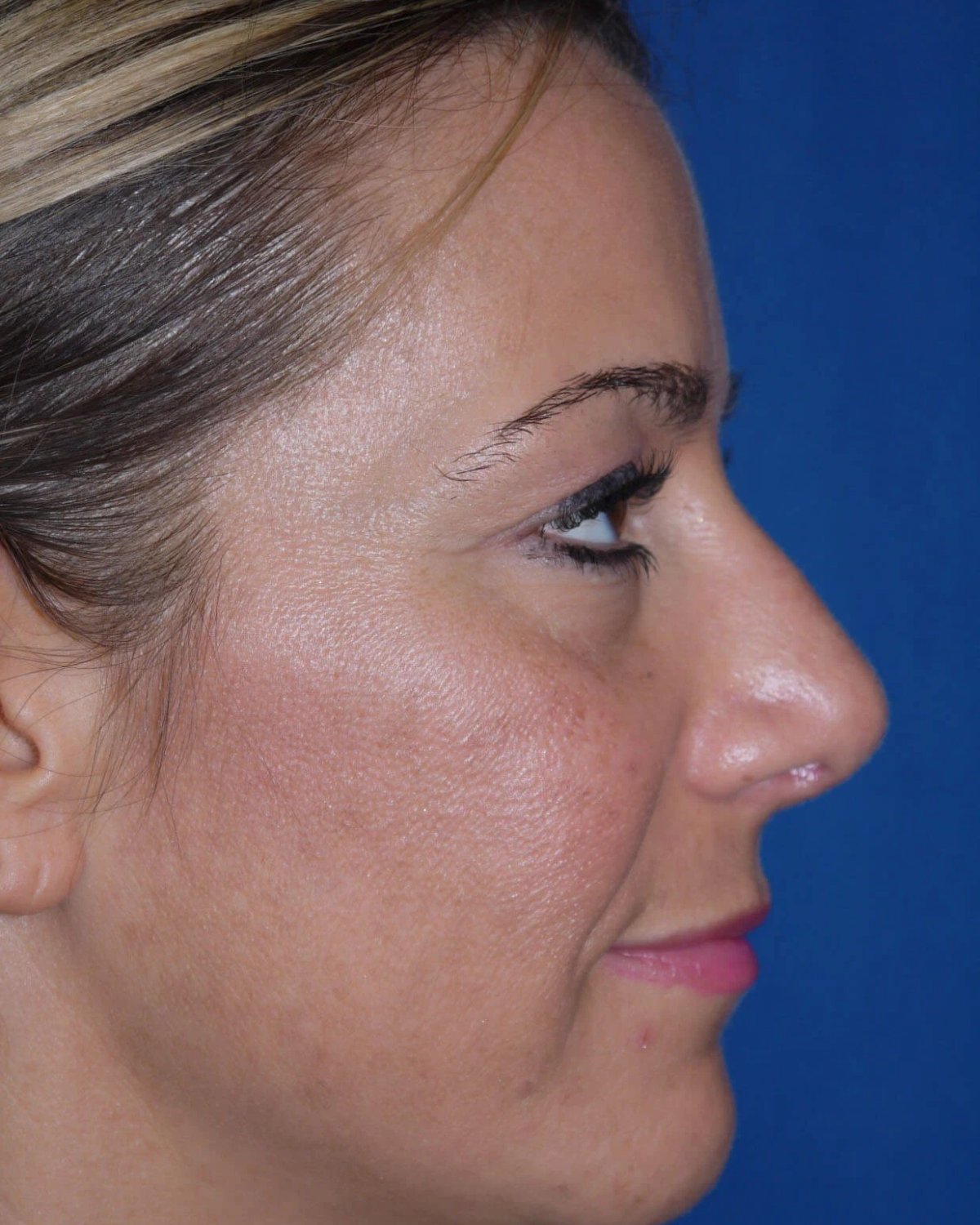 Rhinoplasty — Right Profile view, after