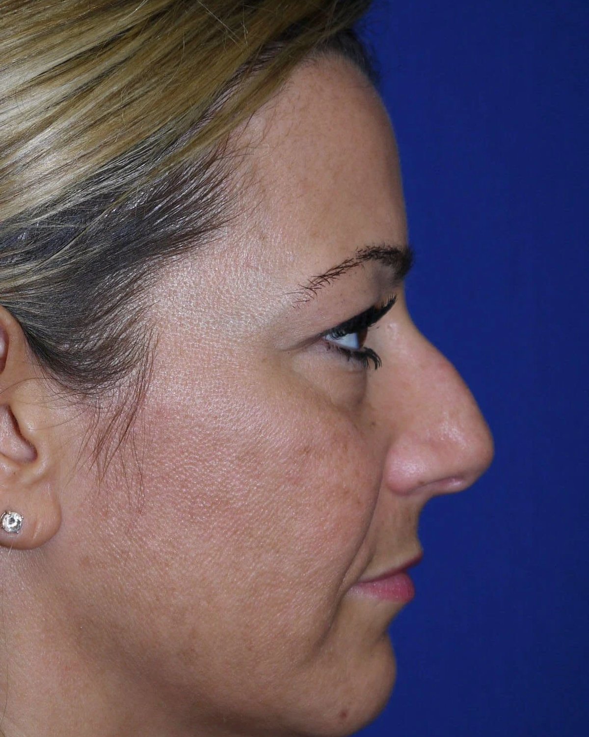 Rhinoplasty — Right Profile view, before