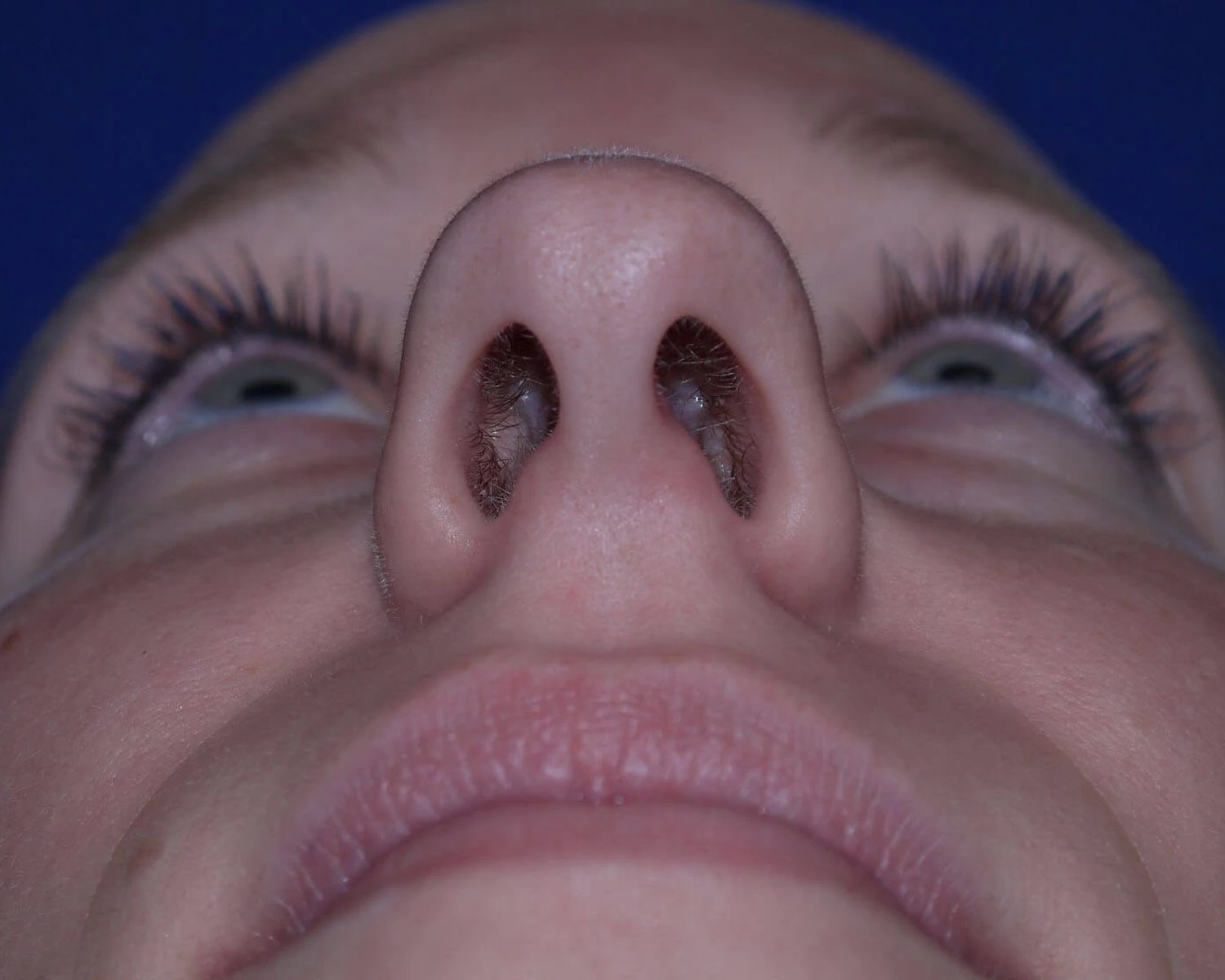 Rhinoplasty before
